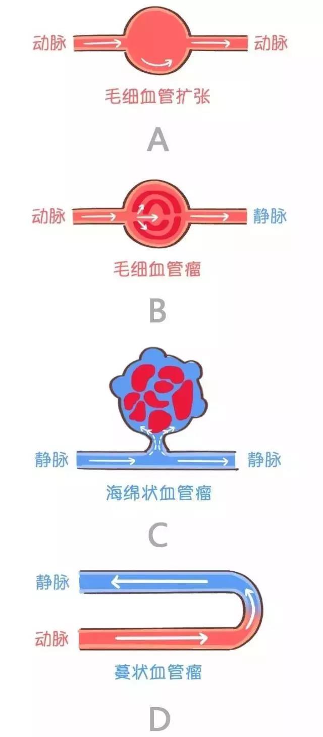 宝宝眼部有紫红色肿块？家长可别不当回事儿，这可能是血管瘤