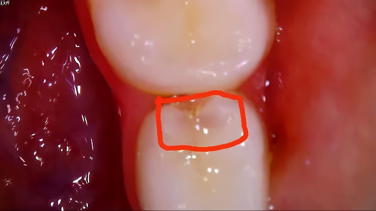 宝宝蛀牙不疼更可怕！后面可能有“敲骨吸髓”手术等着它