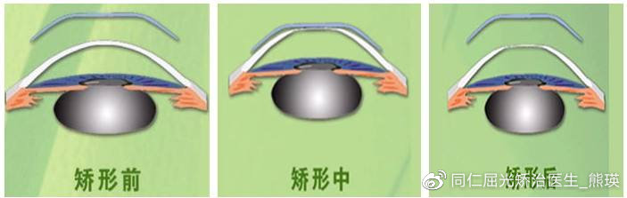 除了近视手术，哪些方法可以让真性近视恢复视力？