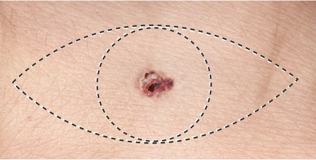 痦子和痣有啥区别(痣与瘊子的区别)_友友