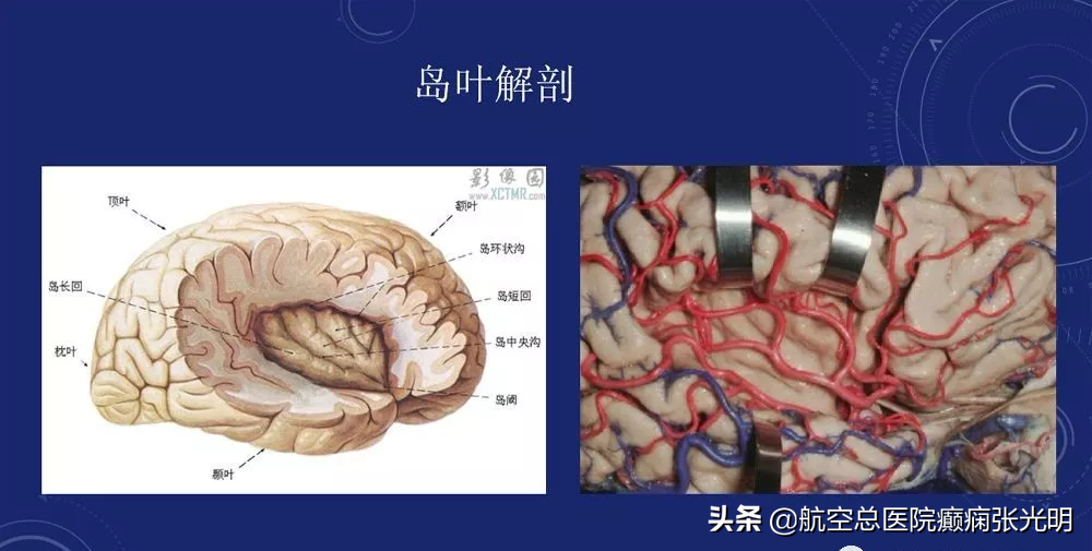 痫怎么读音：深入解析岛叶癫痫的诊断与治疗要点