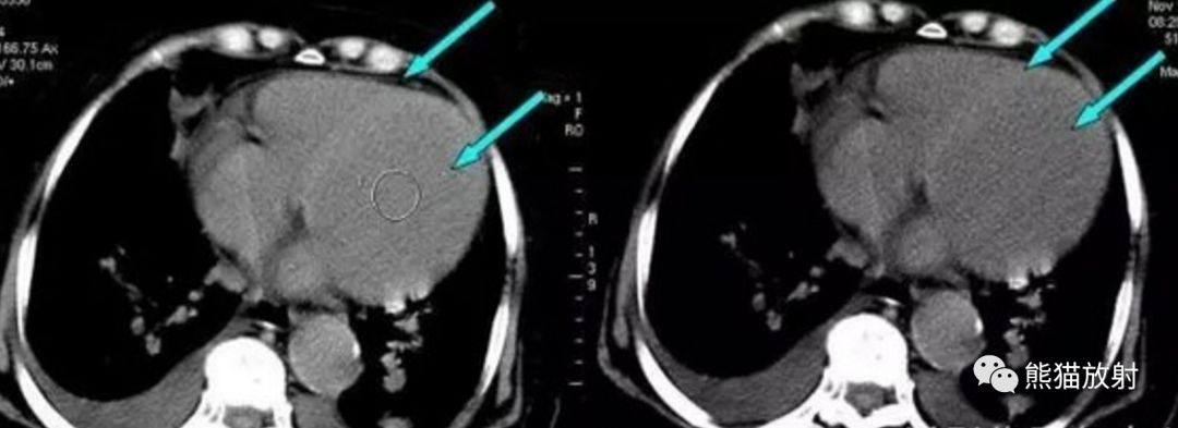贫血丨胸部CT平扫的诊断价值