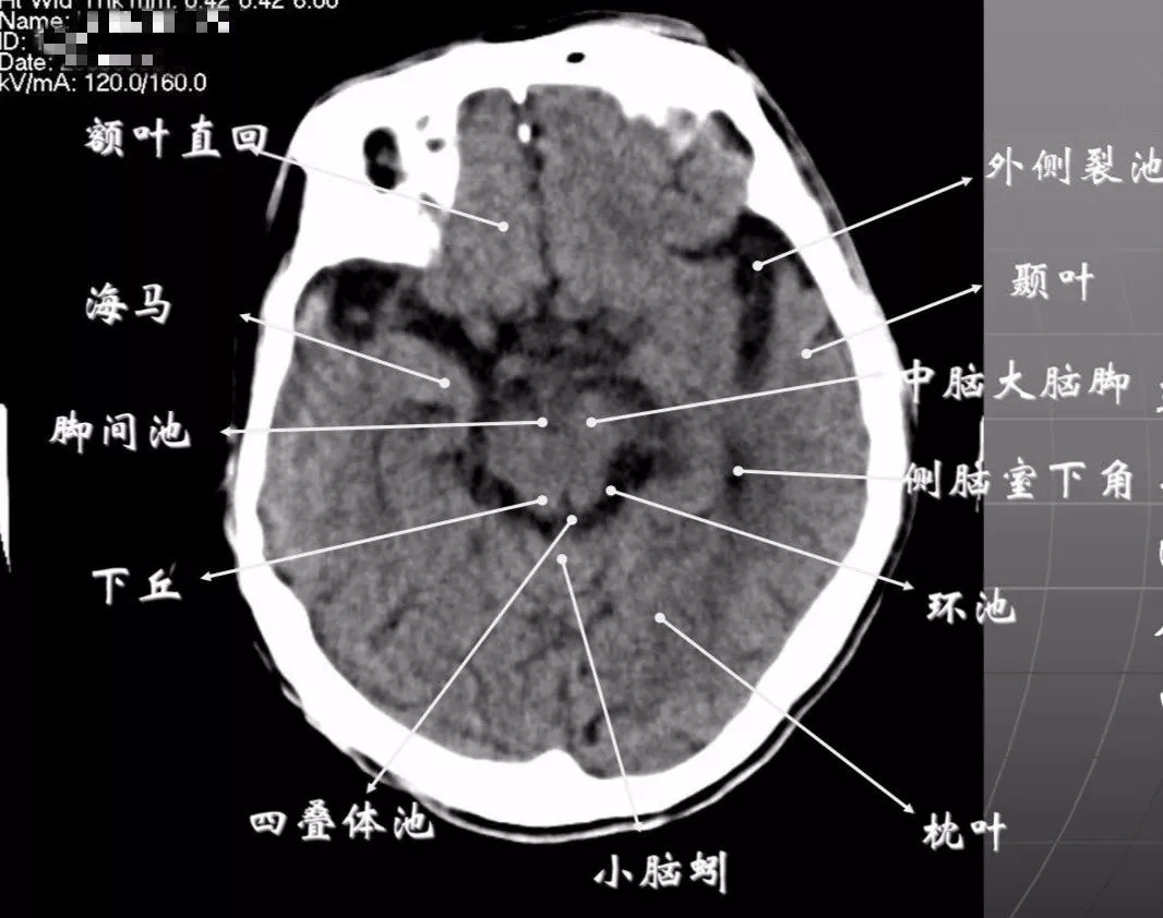 简明又详细的头部CT读片详解，收藏