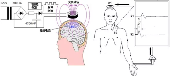 给大脑来场“磁疗”就能治抑郁？华西医院郑重教授这样说