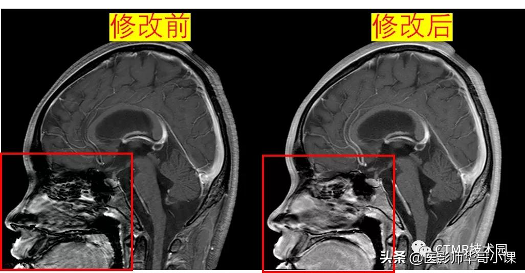 「MRI技术 」做头颅磁共振，为什么这个地方伪影这么重呢？