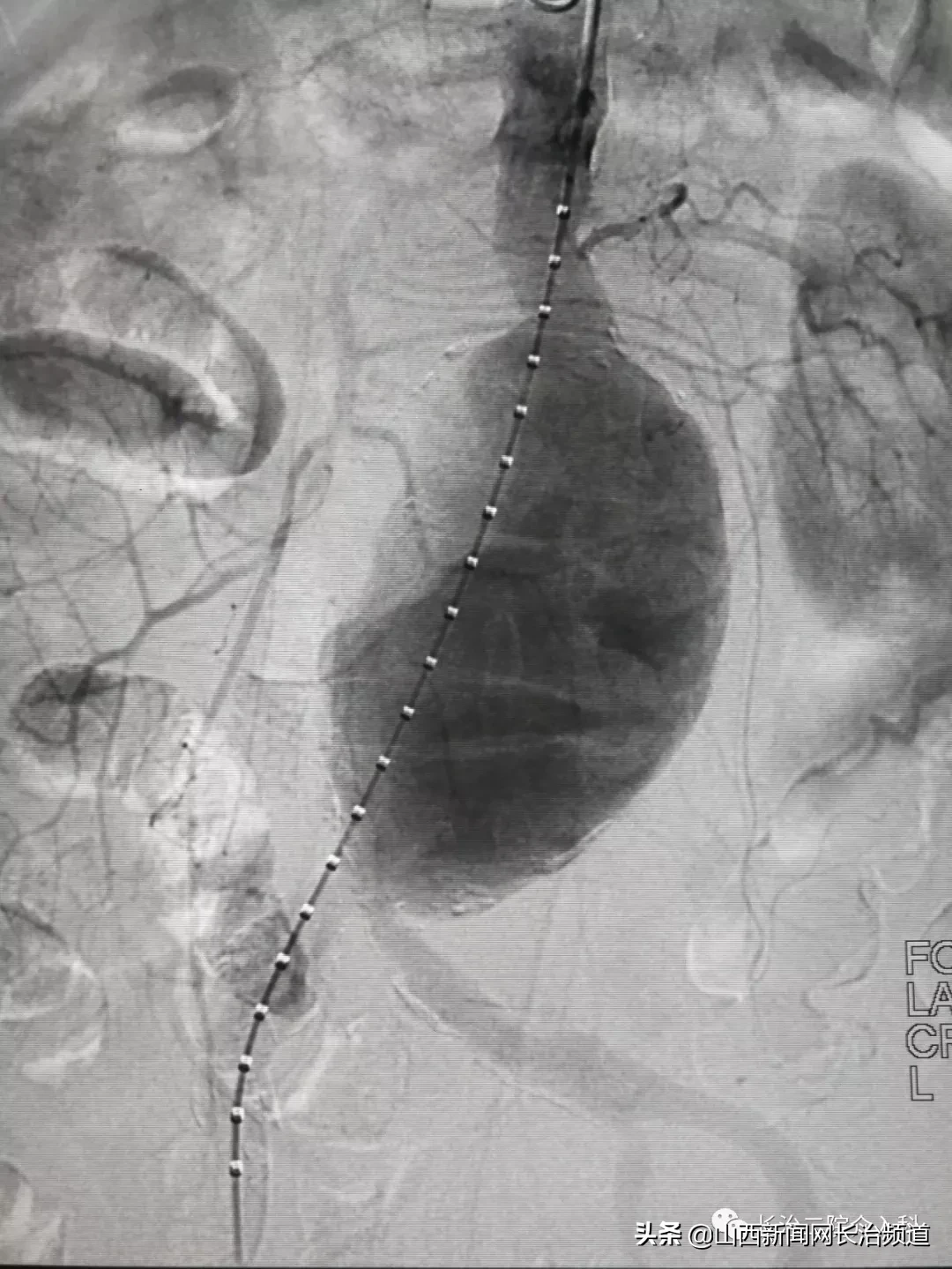 山西甲下血管球瘤哪里做的好(长治二院介入科顺利完成首例巨大腹主动脉瘤腔内隔绝术)