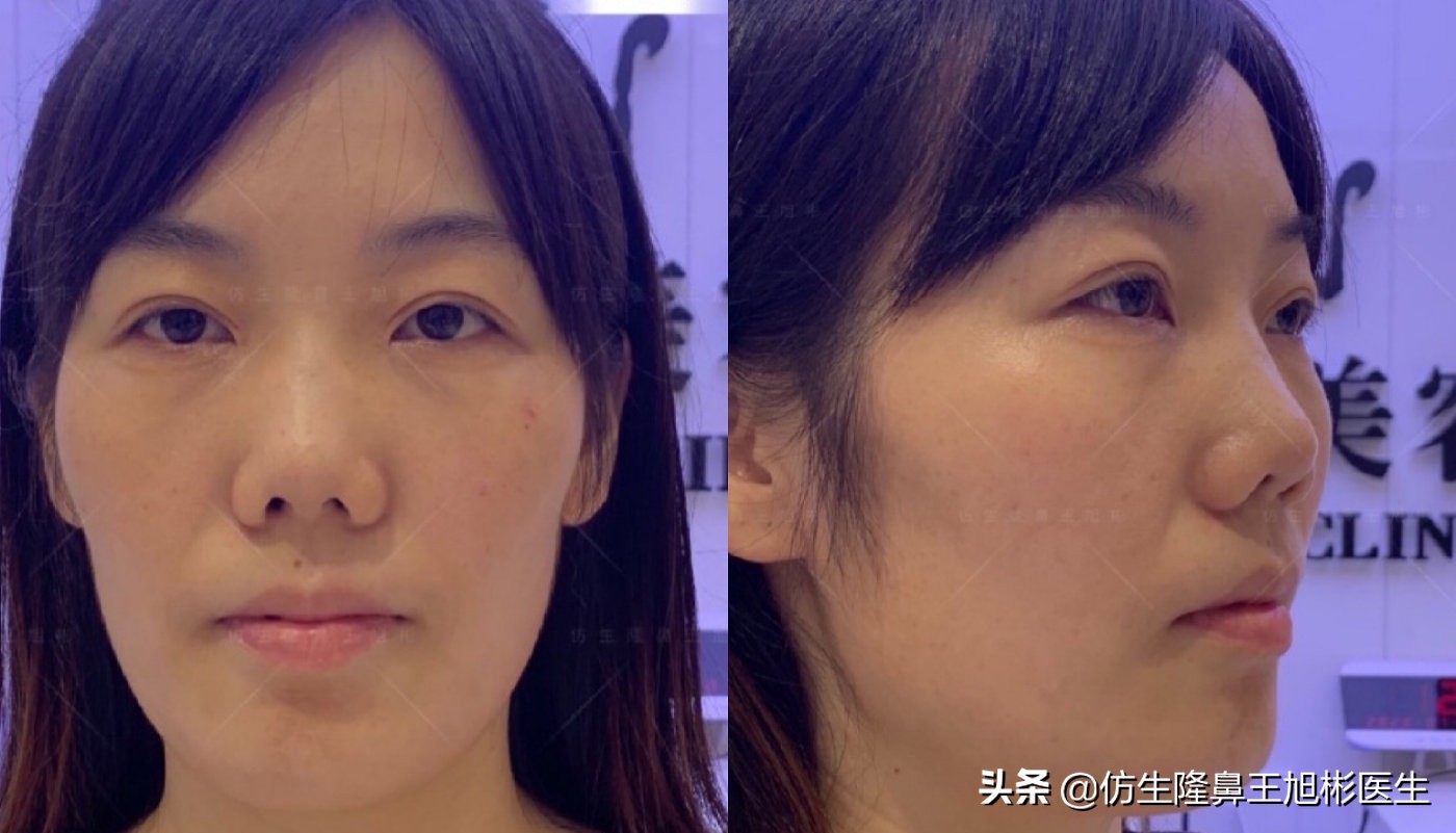 如何定义短鼻，短鼻延长后的改变有多大？