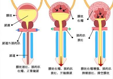 术后常见并发症"尿潴留"如何预防和处理?建议收藏