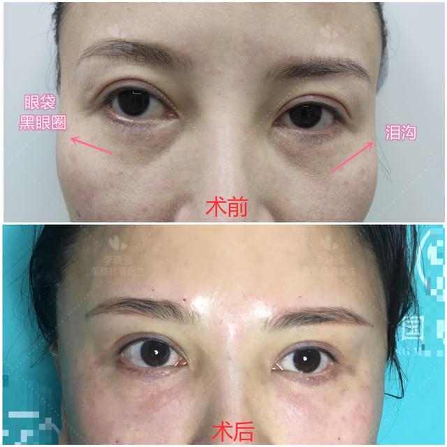 女生遇上面部凹陷，不仅是显老的问题！整形医生教你怎么正确应对