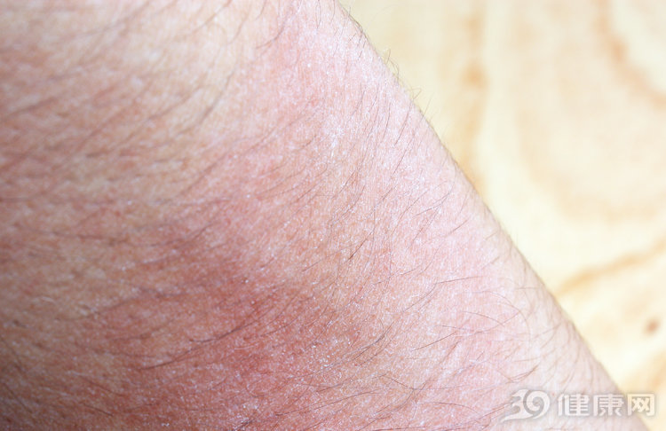疼痛难忍：带状疱疹又名蛇缠腰，2类人易被盯上，如何治疗？
