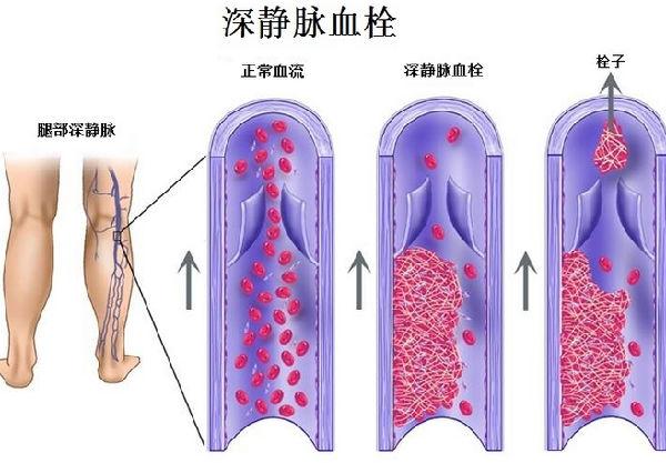 网球肘做什么检查(网球肘是什么？应该如何治疗？粉丝答疑，你想知道的都在这)