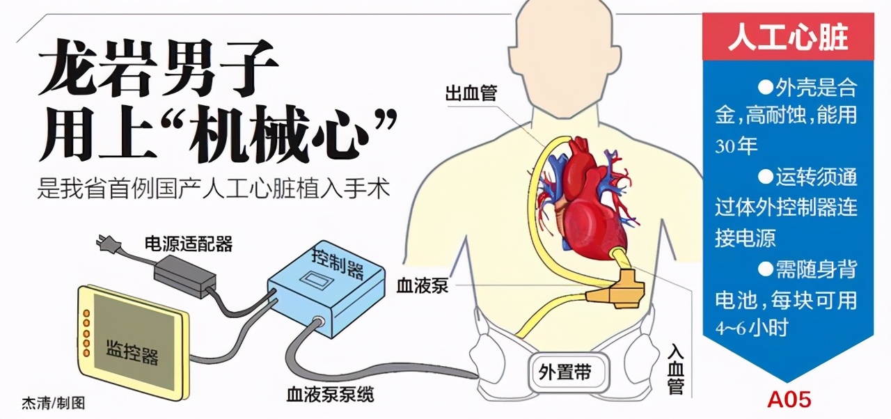 人工心脏多少钱图片