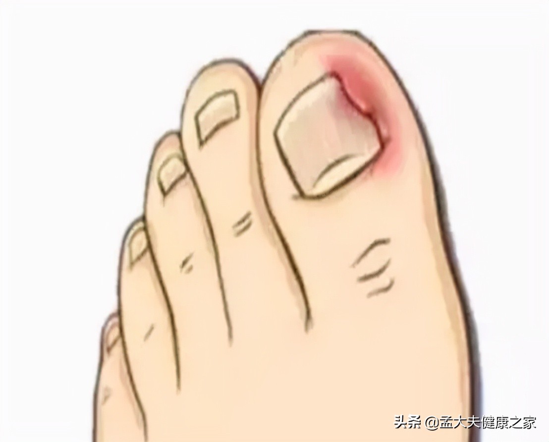 得了灰指甲怎么治？2个治疗方法效果好，安全不复发