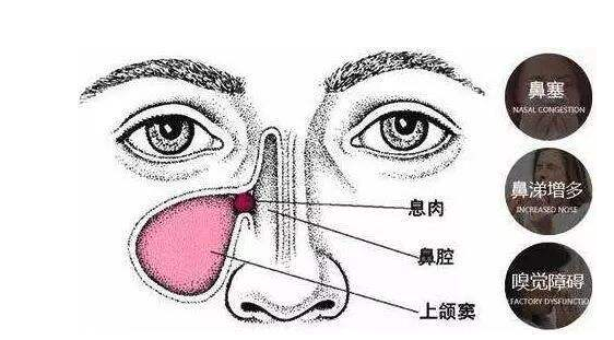 关于鼻息肉的治疗步骤