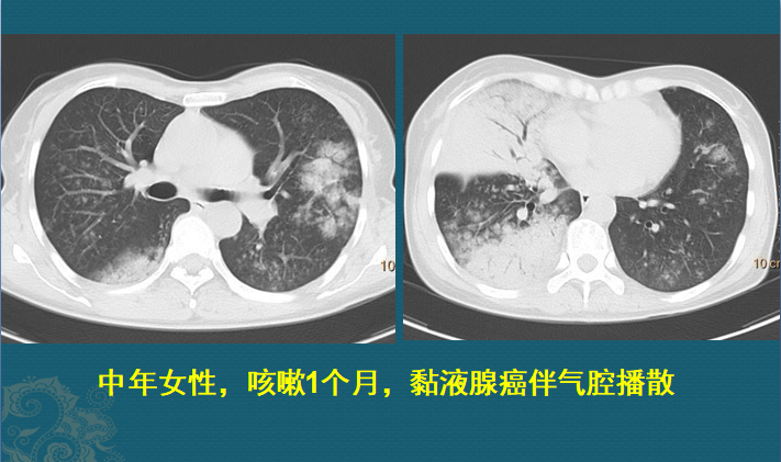 这个肺结节，从8mm发展到晚期肺癌，用了9年