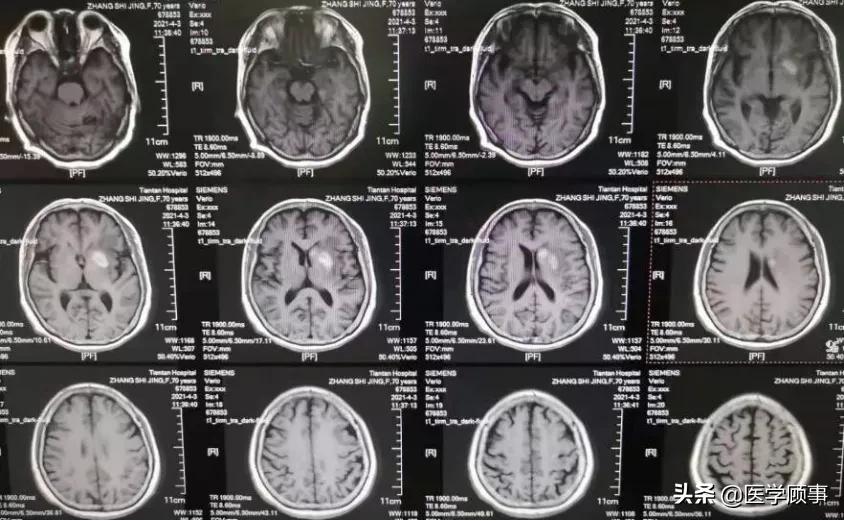 血管内取栓治疗超时间窗的左侧大脑中动脉闭塞