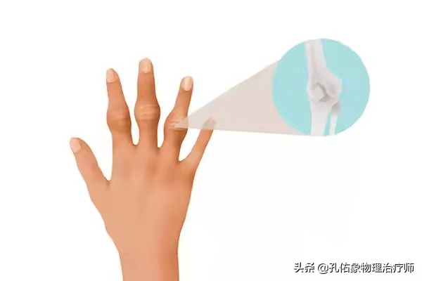 手指肿胀、僵硬、疼痛、有结节，挺挺就过去了？辟谣，趁早诊治