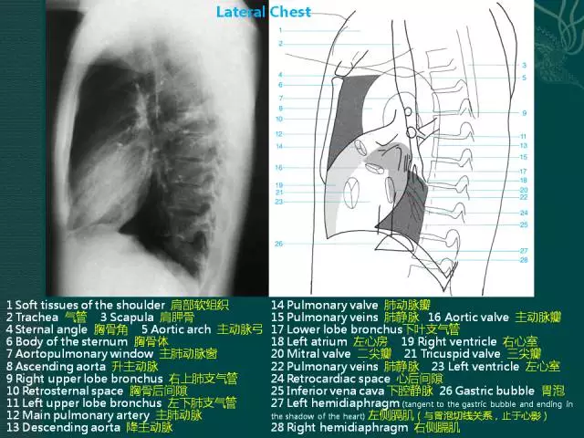 纵隔解剖 + 纵隔疾病X线诊断要点