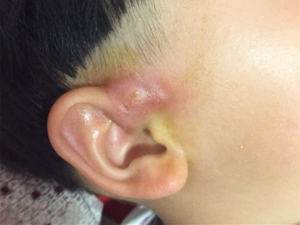 宝宝耳朵上有个"洞",妈妈的这个动作,却把宝宝送进了手术室