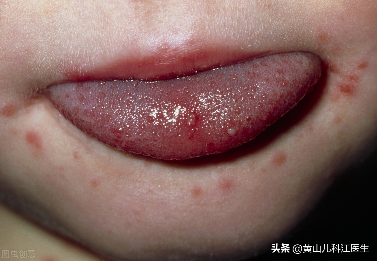 手足口病轻微图片(近期发热的孩子) - 赤虎壹号