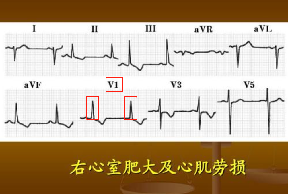 普通人怎么看心电图？医生说：把图上的线条和心脏的跳动结合起来
