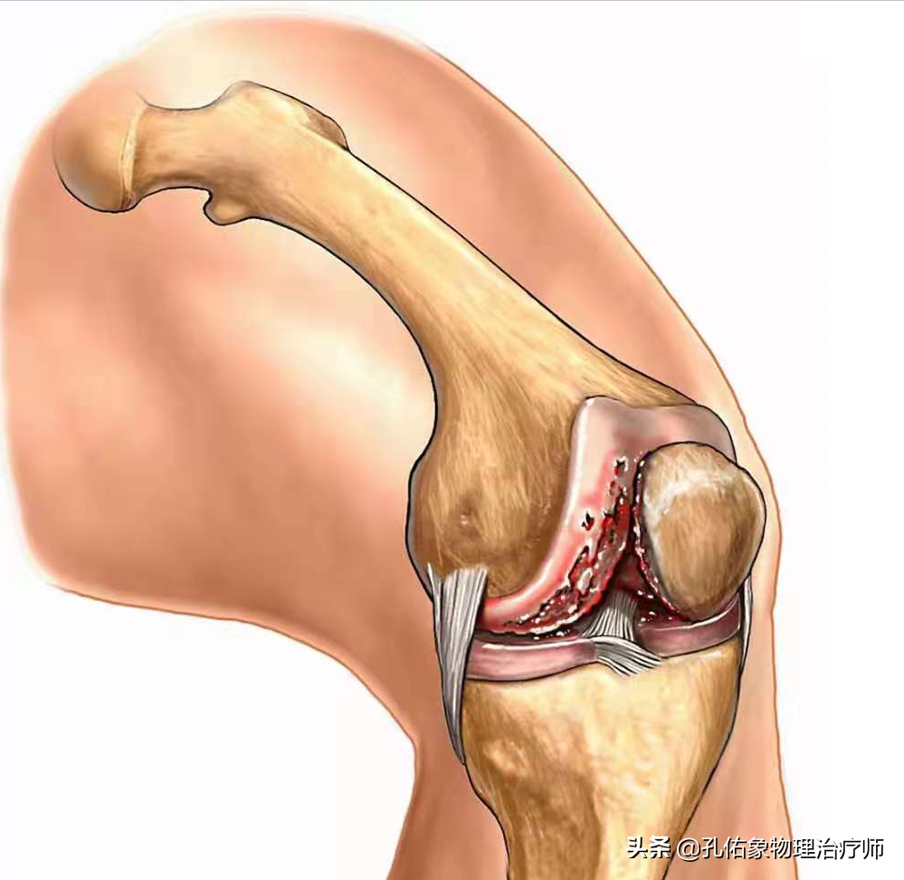 膝关节疼痛的元凶是什么？骨性关节炎吗？要如何应对？请看此文