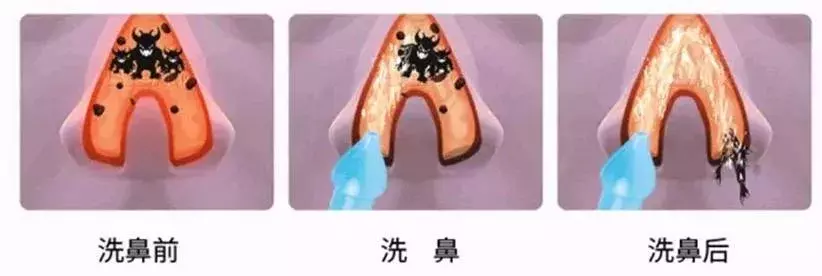 不吃药、无副作用！孩子鼻塞鼻炎反复不好，这个小方法最管用