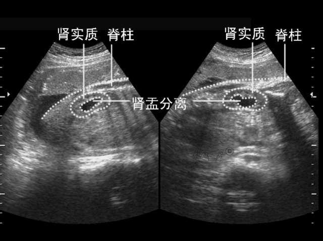 孕妇做四维彩超，显示宝宝肾盂分离，该怎么办？听听医生怎么说