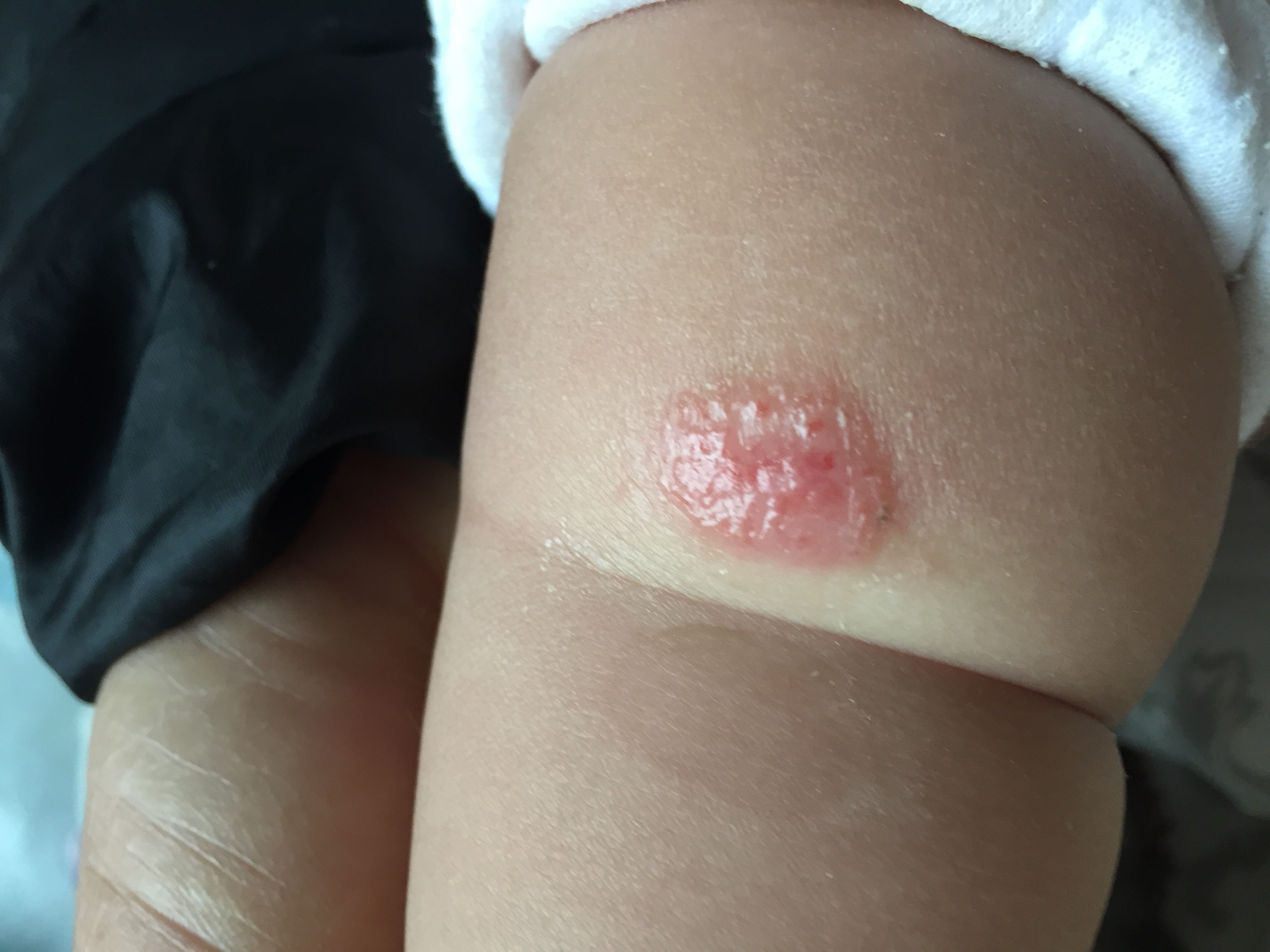 叫了很多年的"湿疹",原来还不是一种病?