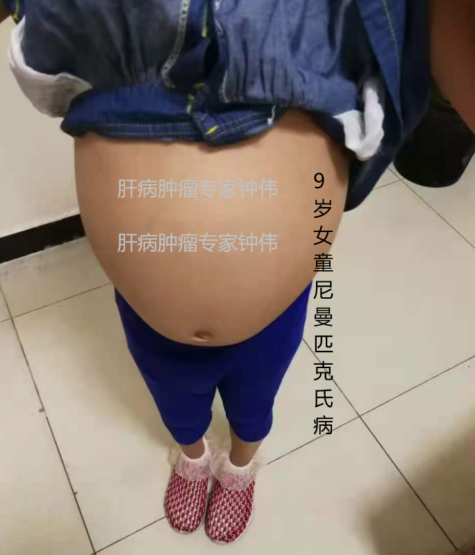 尼曼匹克病(9岁尼曼匹克氏病（肝脾肿大）女孩，8年求治无效，吃中药后好转)