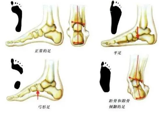 X形腿的纠正