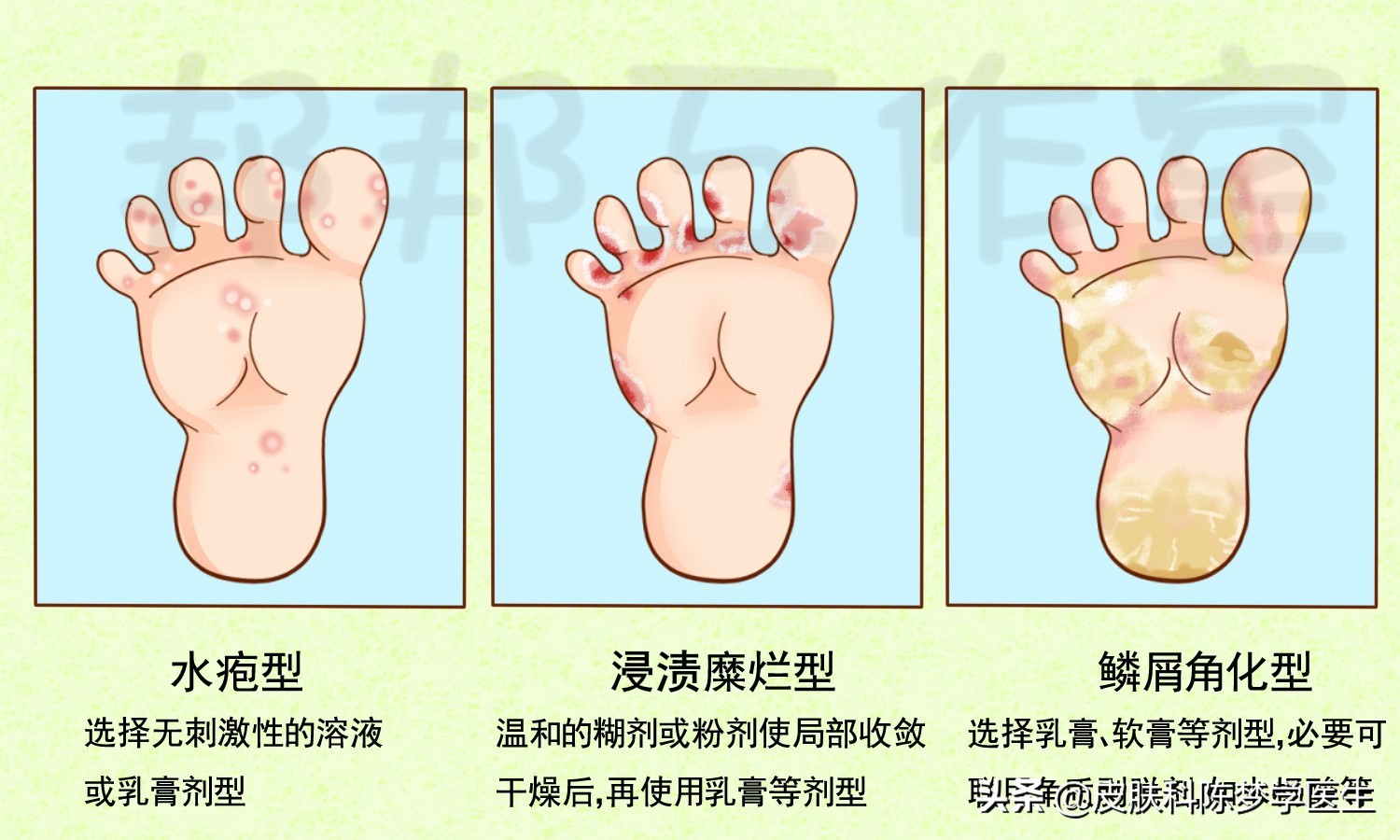 儿童脚气水泡型怎么治图片