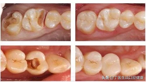 完全不懂，补牙材料这么多，到底怎么选？