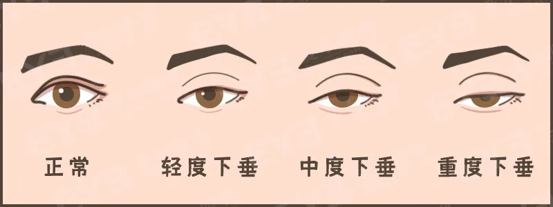 眼皮没力气，不是“睡不醒”，而是“上睑下垂”这种病