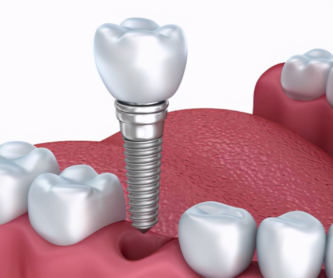 植入到口腔内的“螺丝”真的会生锈吗？看看专家怎么说