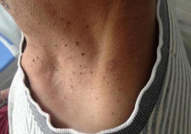 皮赘物皮赘物是皮肤出现的一些增生组织,其实是一种正常的皮肤问题