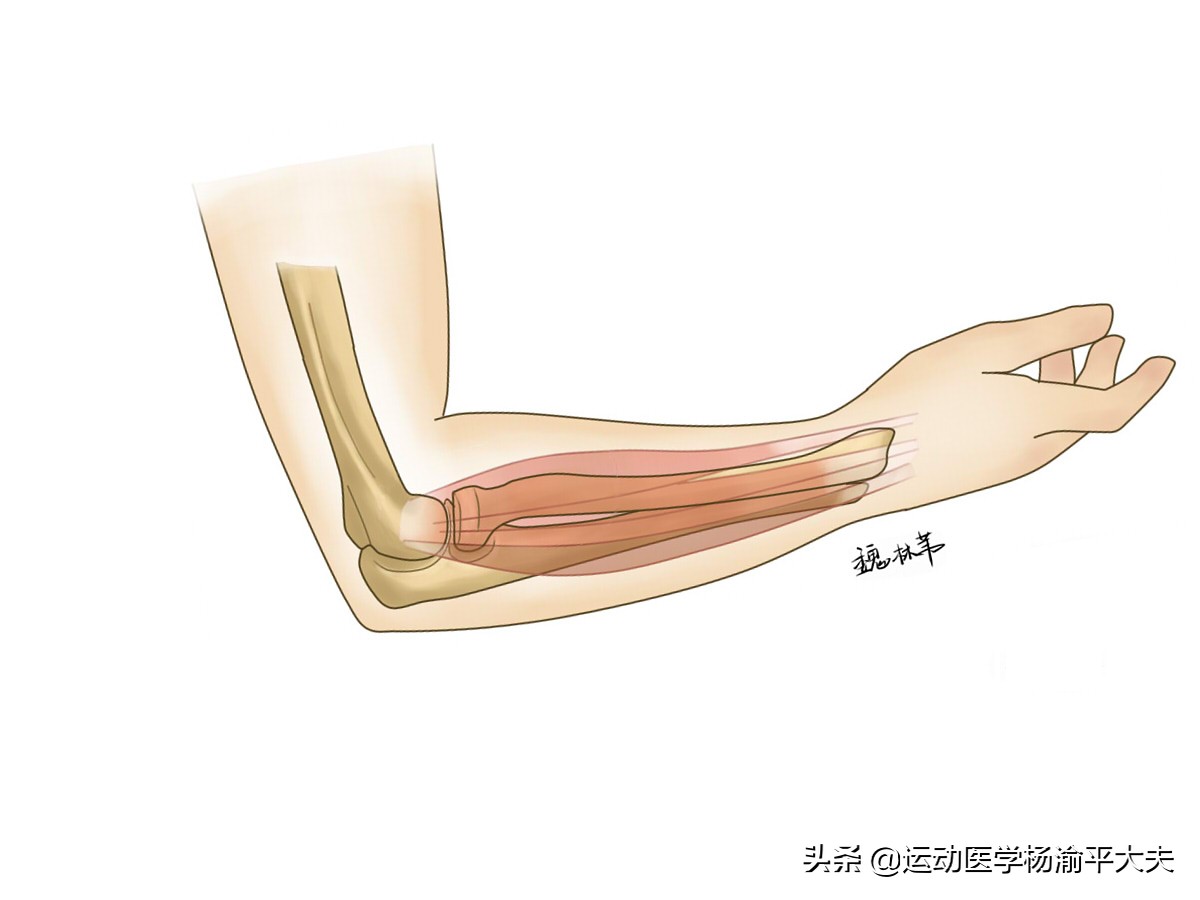 网球肘最怕三个动作(什么是治疗网球肘有效办法？这五个动作助你康复事半功倍)