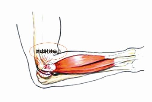 拔火罐能治网球肘吗(网球肘，不可怕，及时休息是关键)