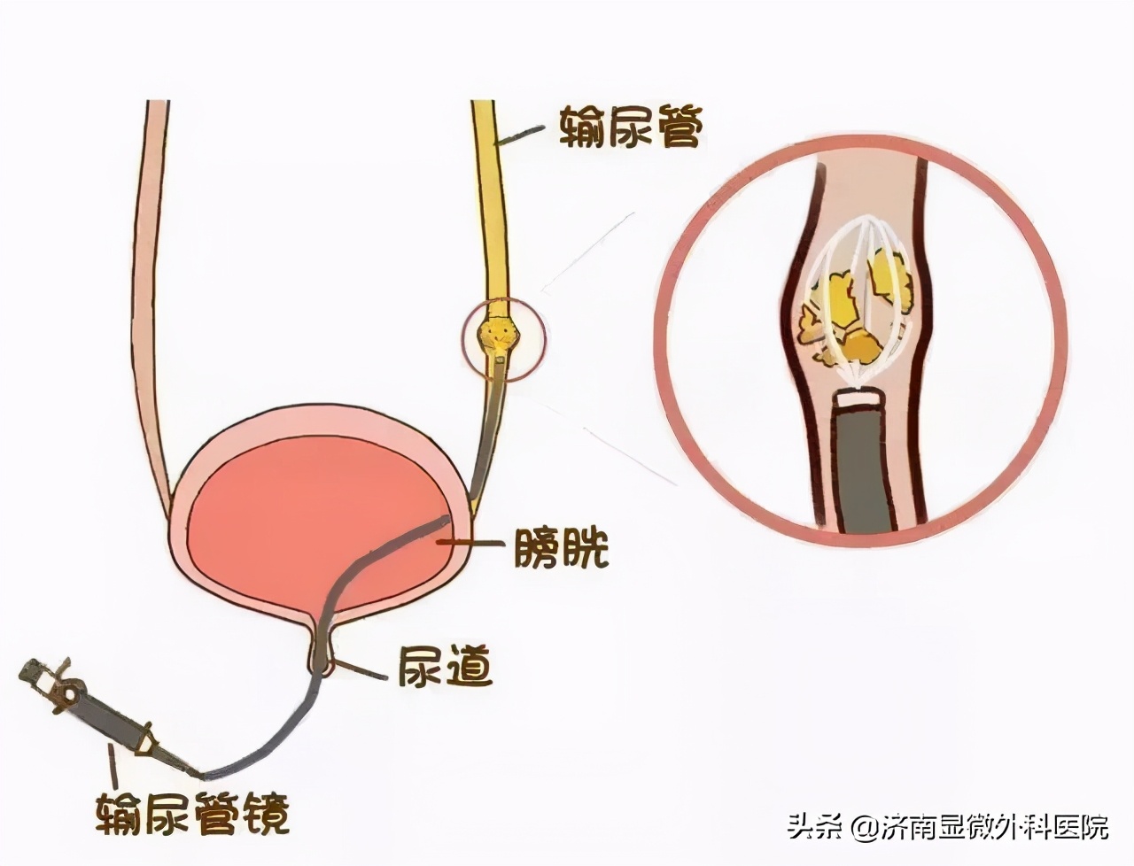 输尿管软镜+钬激光碎石取石术，超微创术让结石无处可藏