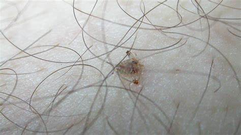 女子眼睛瘙痒难耐，医生从睫毛夹出17只阴虱！是怎么染上的？