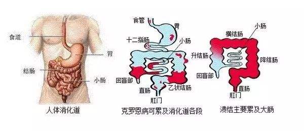 是不是炎症性肠病，临床常需做哪些检查项目，这个你真要了解下