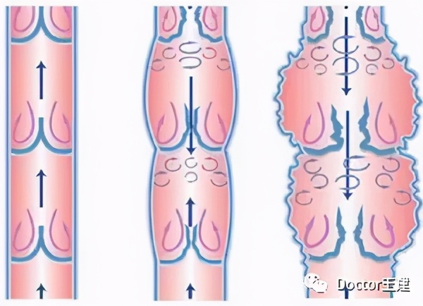 Doctor王建医学科普2：精索静脉曲张