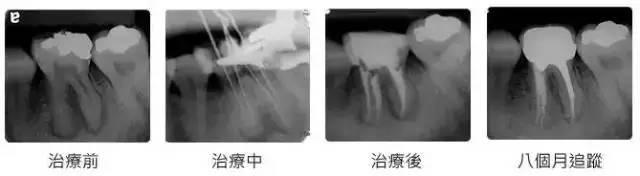 抽完牙神经后，牙齿变成“死牙”？还能要吗？