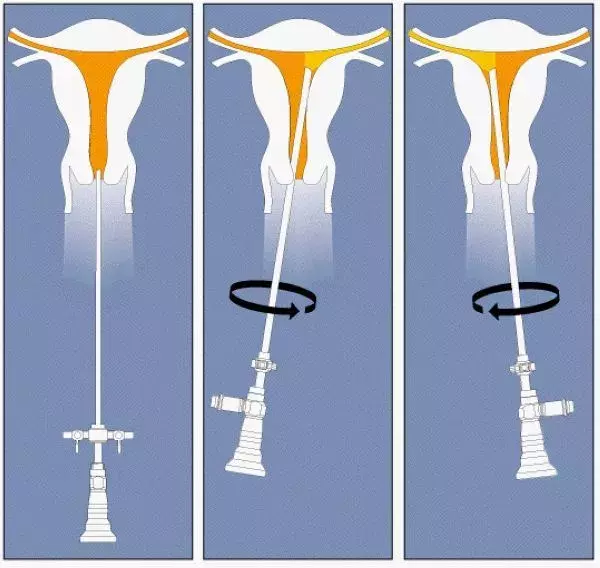 宫腔镜是个啥？有啥用？到底是检查还是手术？