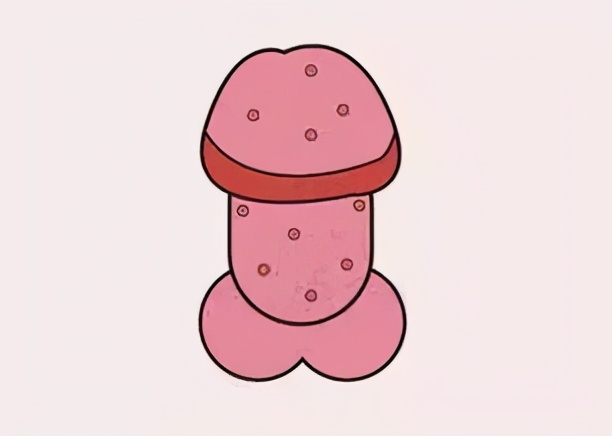 龟头上有小红点,一般考虑是包皮龟头炎