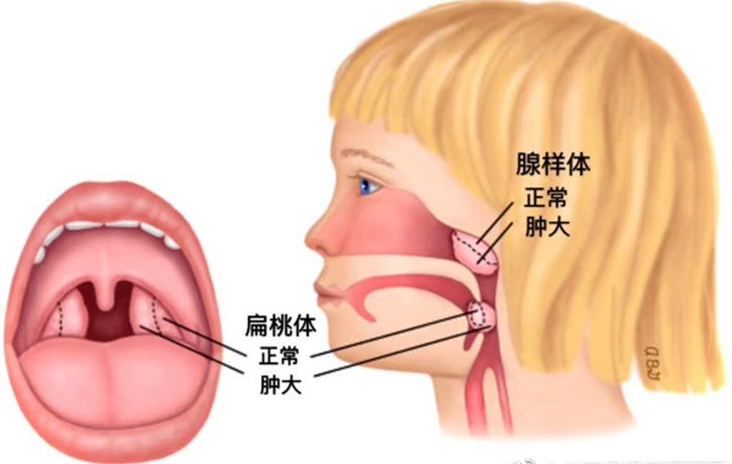 辟谣：宝宝打呼噜说明睡得香？宝妈别大意，这几种情况需注意