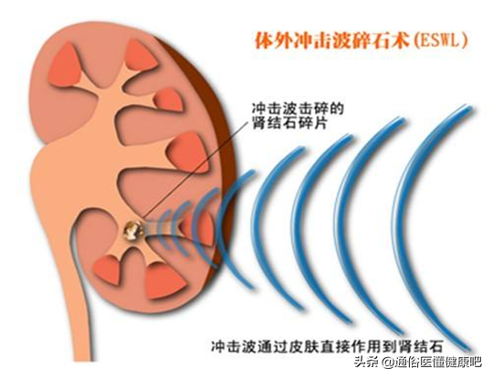 体外冲击波“碎石”和输尿管软镜“取石”，谁更“胜”一筹？