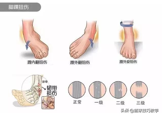 篮球坏了咋修理(「科普」打球崴脚了怎么办？)