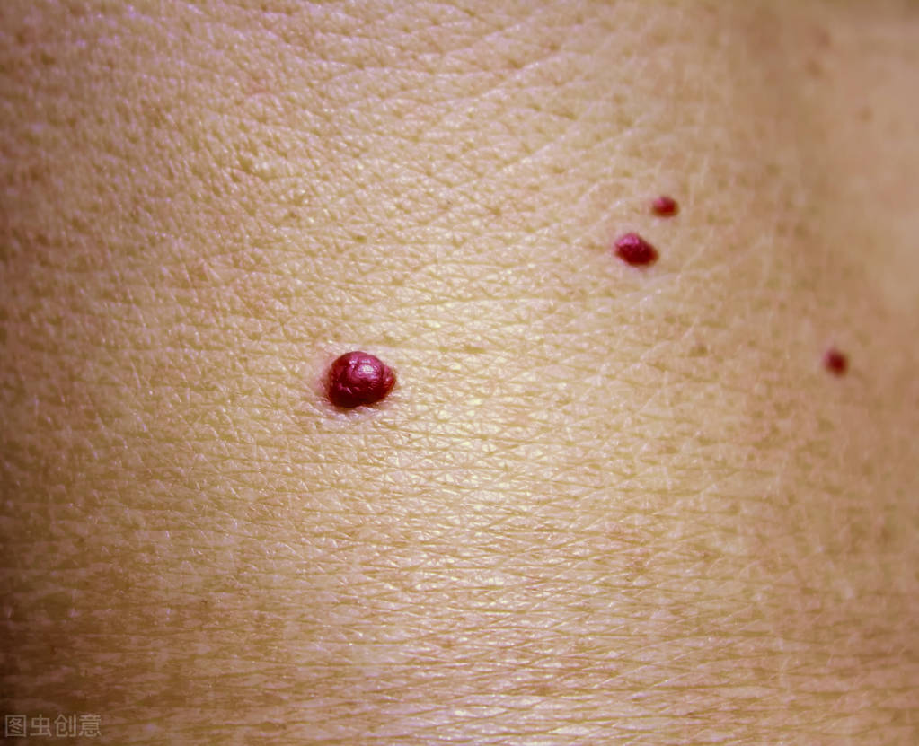 血管瘤图片初期(孩子身上长着血红色疙瘩是什么) - 赤虎壹号