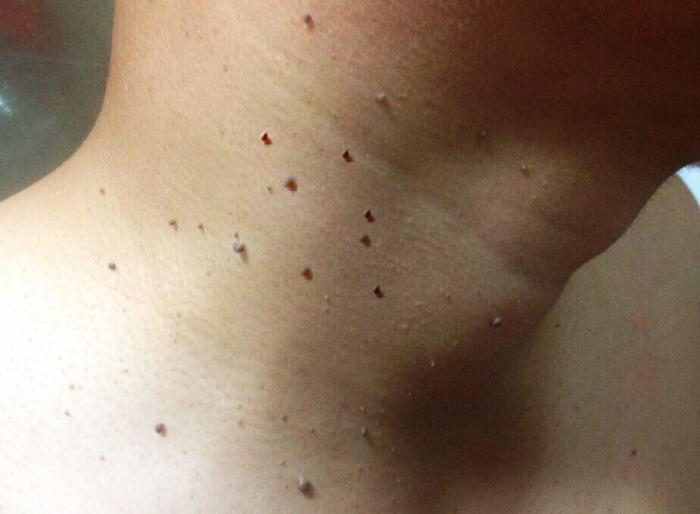 脖子腋下长的"小肉粒"是什么?能用手抠掉吗?若你也有,要注意